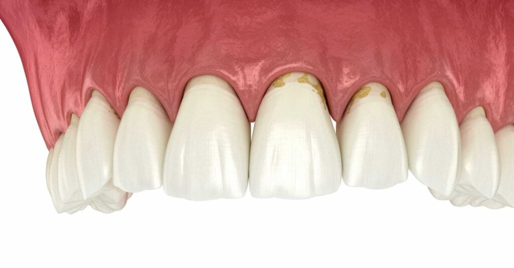 Che cos'è la parodontite 1 Studio dentistico a Leinì